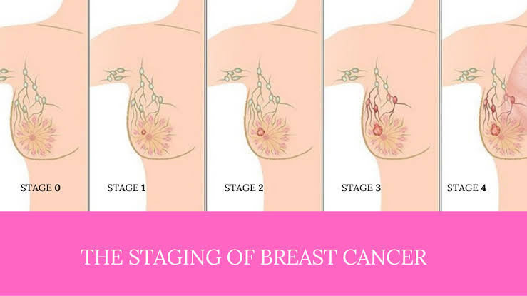 Breast Cancer Stages