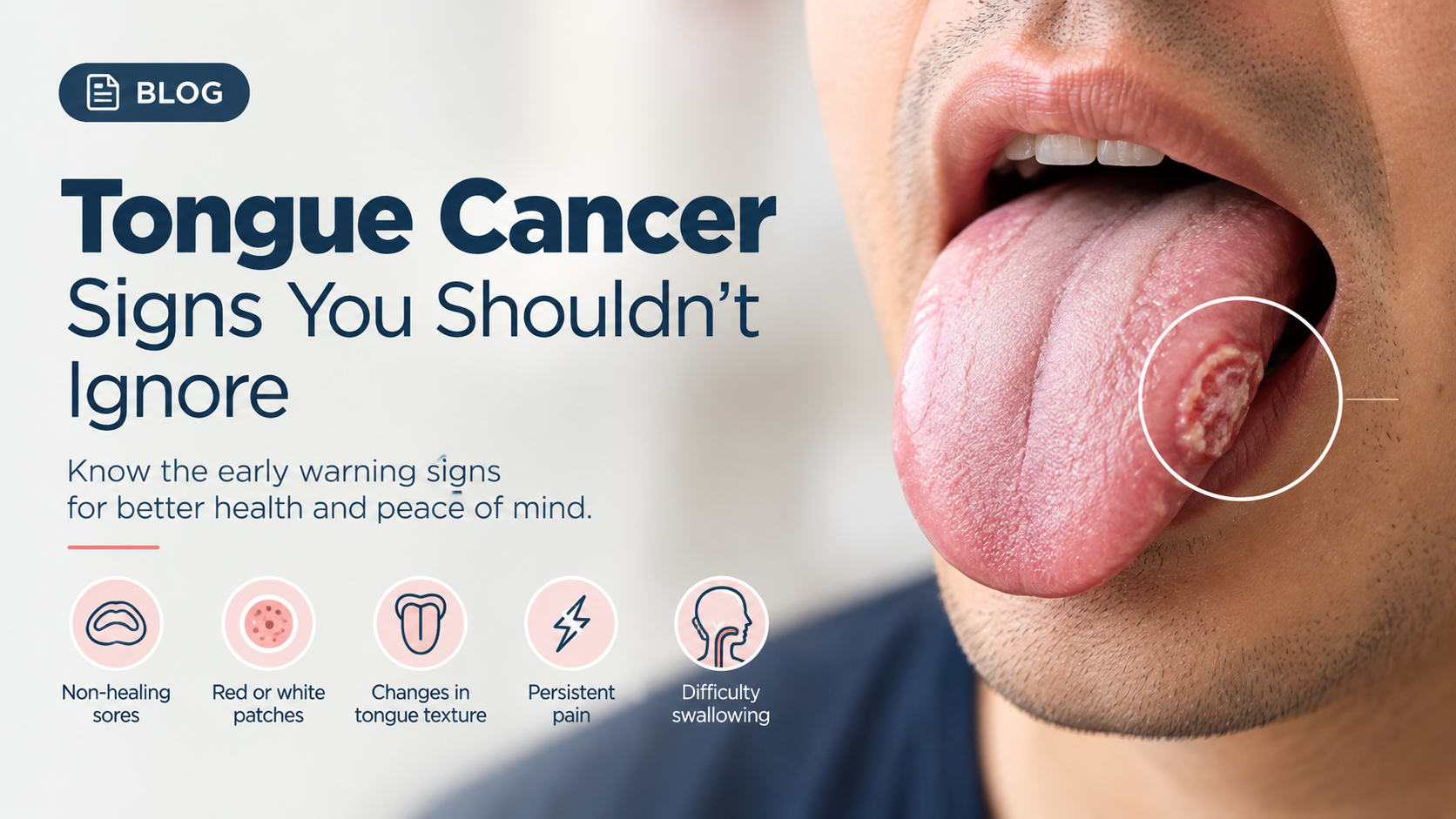 tongue cancer signs