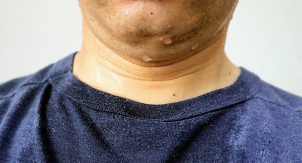 Lymphoma