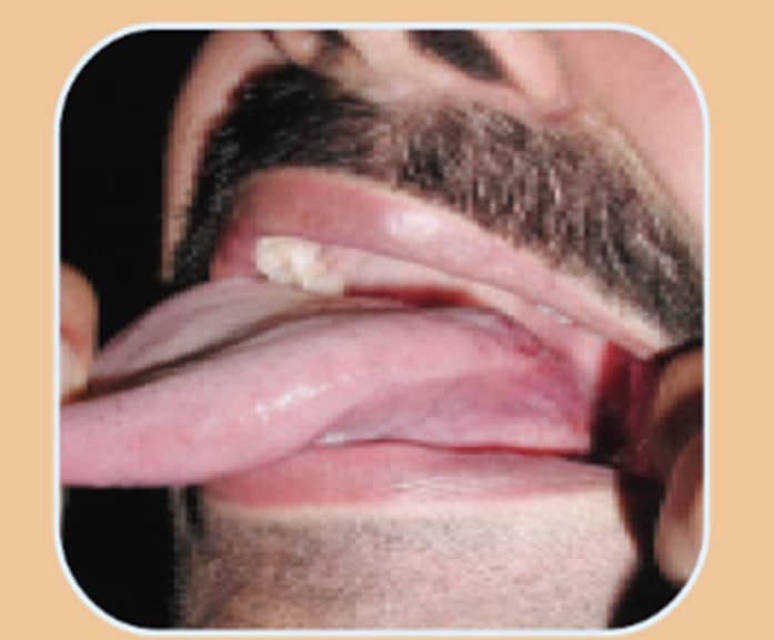 Oral Cancer